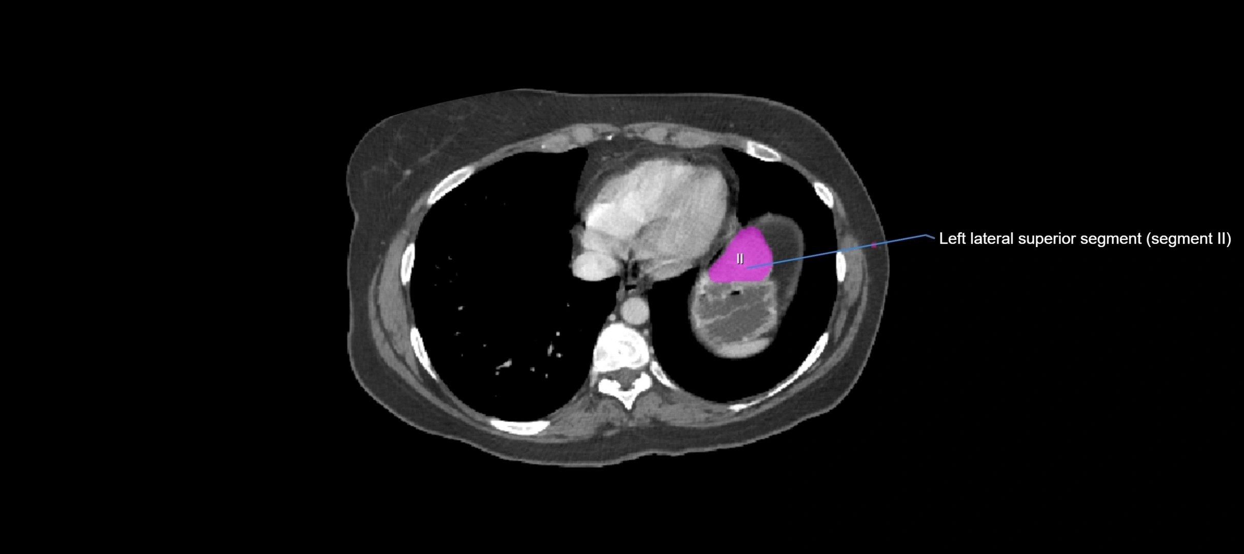 CT liver segments axial cross sectional anatomy labelled image-00077.webp
